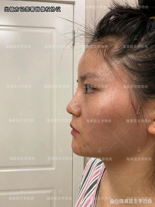 做了鼻子多久能化妆_隆鼻后多久能化妆？恢复期化妆指南