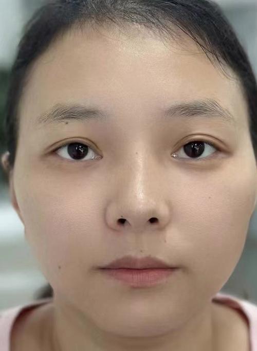 不化妆照片鼻子看着不挺_不化妆鼻子塌？医美或真管用！