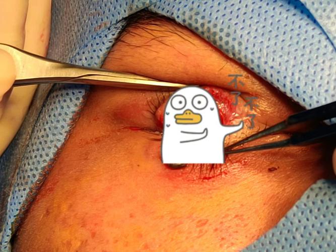 下眼睑没有睫毛是什么原因_睫毛缺失？遗传受伤疾病都可能导致！