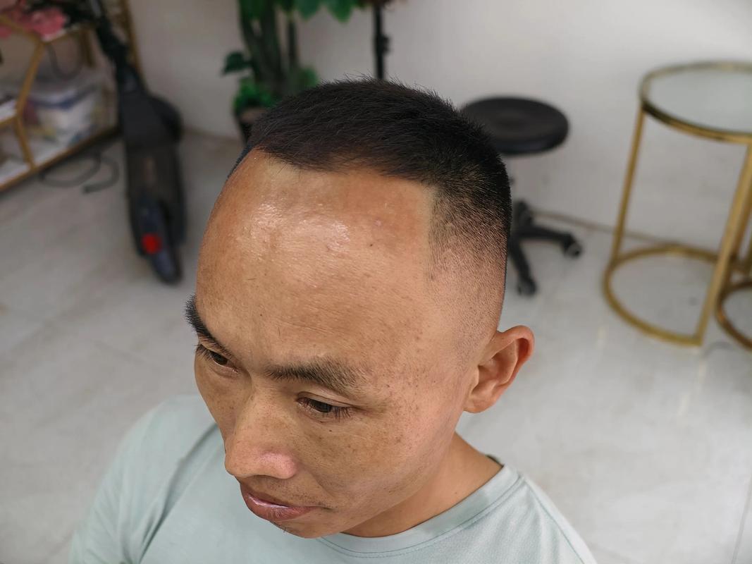 严重m头发型_M型发际线？试试这些发型，显年轻又防脱！