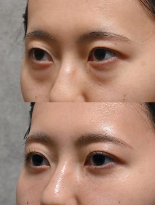 现在年轻女性化妆后眼袋教大_遗传熬夜致眼袋？化妆护理巧遮瑕！