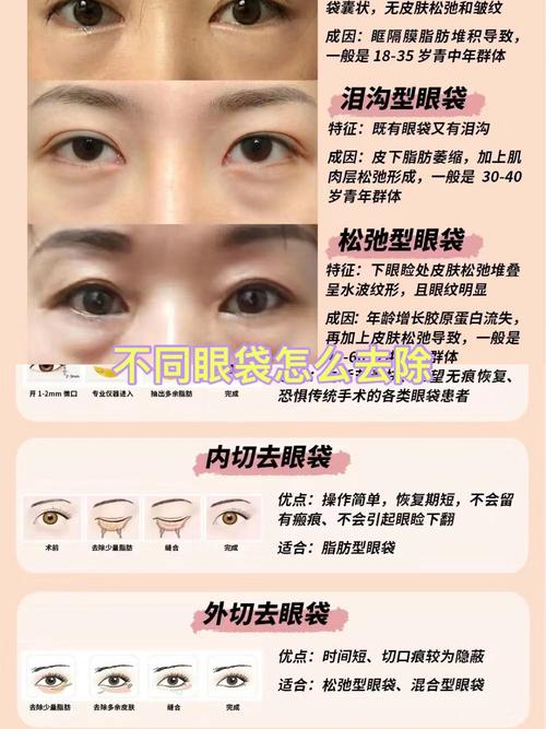 三天消除眼袋小妙招_天然方法去眼袋，告别熊猫眼