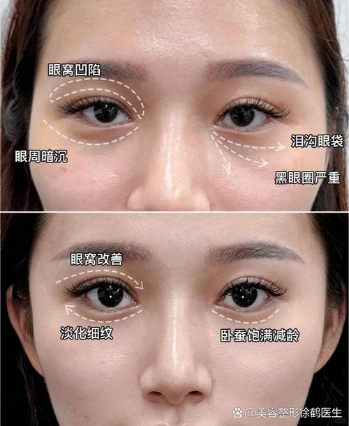 眼窝凹陷怎么恢复饱满的方法_填充按摩选对法