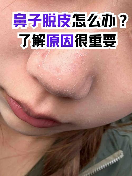 为啥一化妆鼻子就脱皮_鼻子两侧化妆脱皮？别慌，这样修护就对了！