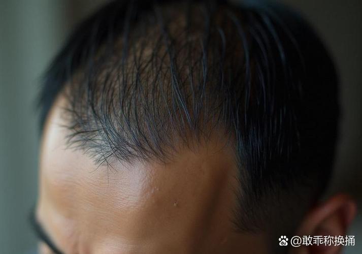 一摸头发头皮就针扎似的疼_头皮触痛怎么办？