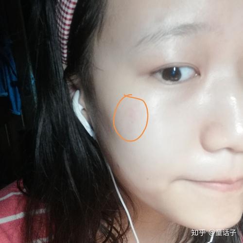 被卷发棒烫了会怎么样_卷发棒烫伤处理及疤痕预防