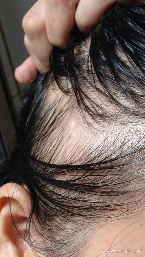 三天洗一次头掉200根头发正常吗_掉头发多怎么办？