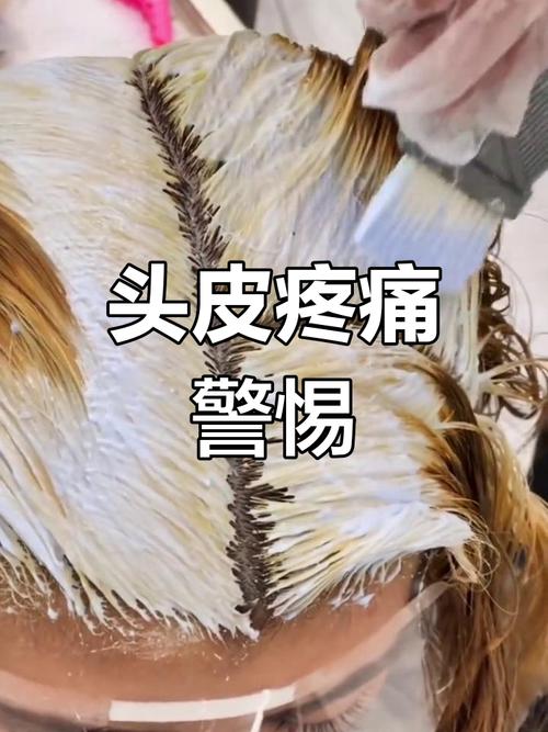 漂完头发后一摁头皮很疼正常吗_漂发头皮痛怎么办？