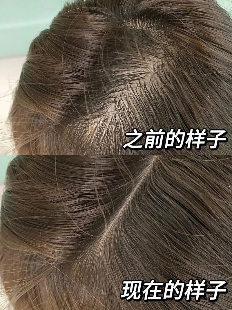 稍微一扎头发就头皮疼_扎头过紧痛？松松绑，头皮爽！