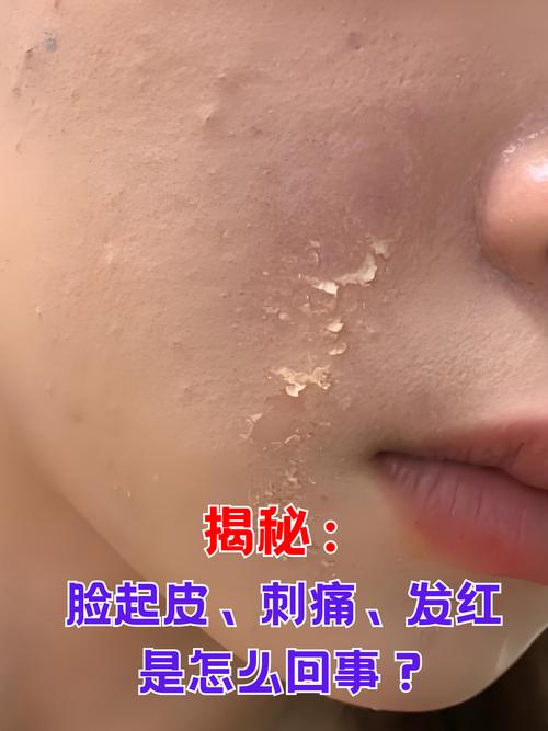 用完化妆品脸上起皮怎么回事_脸上起皮?选对护肤品,别过度清洁 用完化妆品脸上起皮怎么回事_脸上起皮?选对护肤品,别过度清洁