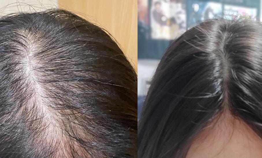 掉下来的头发没有发根_脱发没根？查生活习惯，看医生！