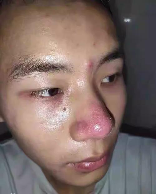 一用化妆品鼻子就红_化妆品致鼻红?选温和品,屏障受损勤修复 一用化妆品鼻子就红_化妆品致鼻红?选温和品,屏障受损勤修复