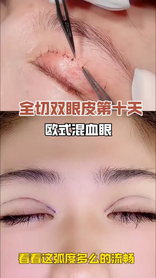 全切双眼皮术后多久可以化妆_全切双眼皮术后多久能化妆？