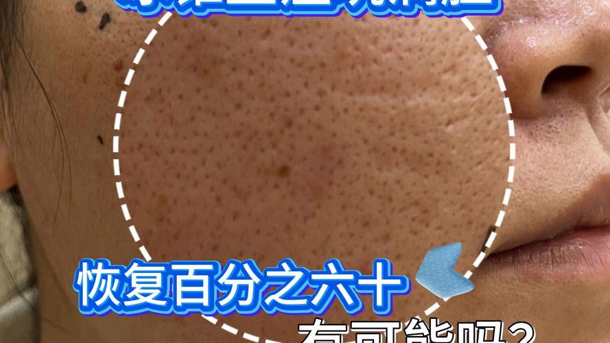 冰锥痘坑能被化妆品遮盖吗_冰锥痘坑怎么办？医美改善效果佳