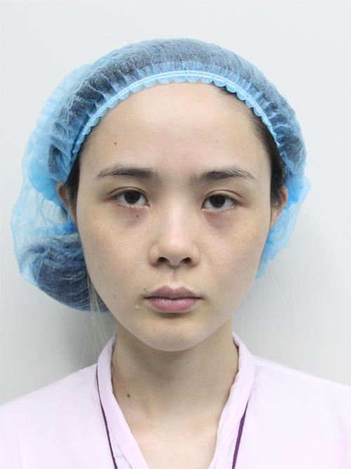 假体隆鼻多久可以化妆_假体隆鼻后几天能化妆？