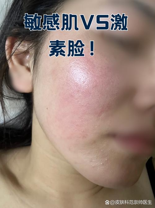 激素化妆品停用后_停用激素化妆品后如何修复皮肤屏障? 激素化妆品停用后_停用激素化妆品后如何修复皮肤屏障?