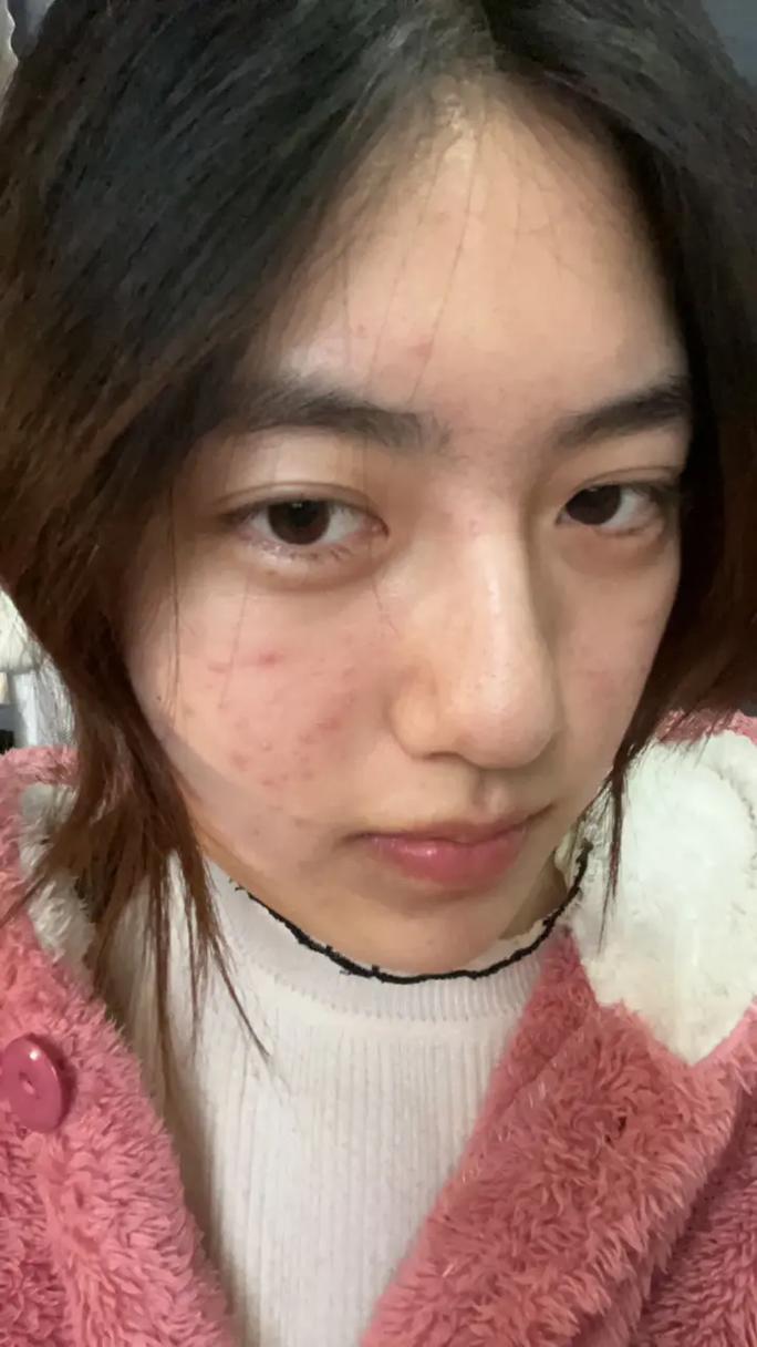 痘痘没消干净能化妆嘛_不干净化妆加重痘痘？正确护理告别痘痘！