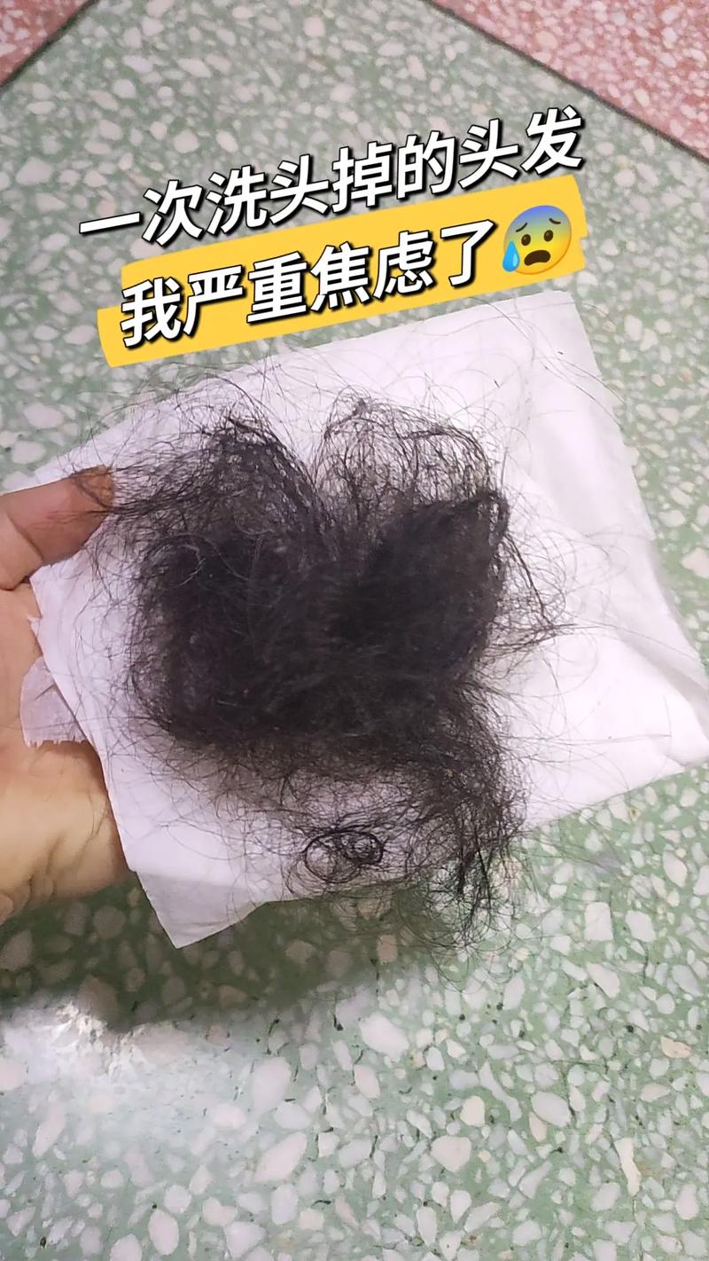 洗一次头掉二三十根头发正常吗_洗头掉发二三十根是正常的