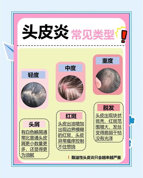 用手摸头发头皮就疼怎么回事_头皮触痛原因多，注意休息别刺激，持续疼痛快就医