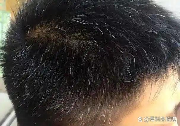 拔掉白头发会不会越长越多_别信谣言！拔白发不增多，伤毛囊