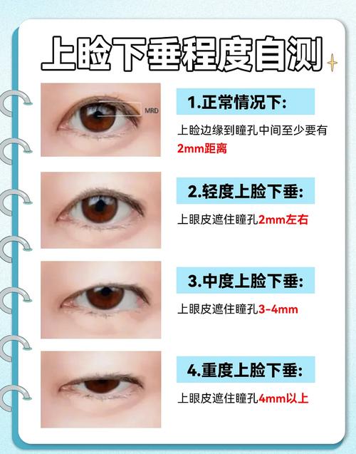上眼皮下垂恢复锻炼法_眼皮下垂怎么办？多种方法改善