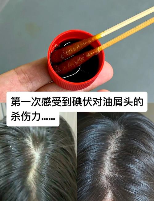 碘伏洗头发的功效与方法_碘伏洗头需谨慎，按比例试用防副作