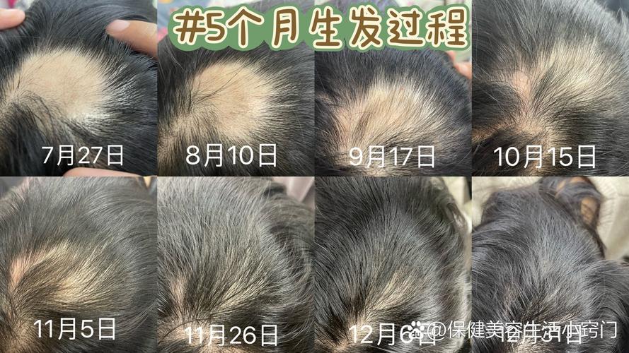 秃了的地方还能长出头发吗_毛囊活不活？秃了看这方法！