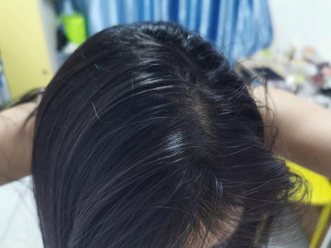 翻动头发时发根疼正常吗_发根疼？头皮炎压力大是主因