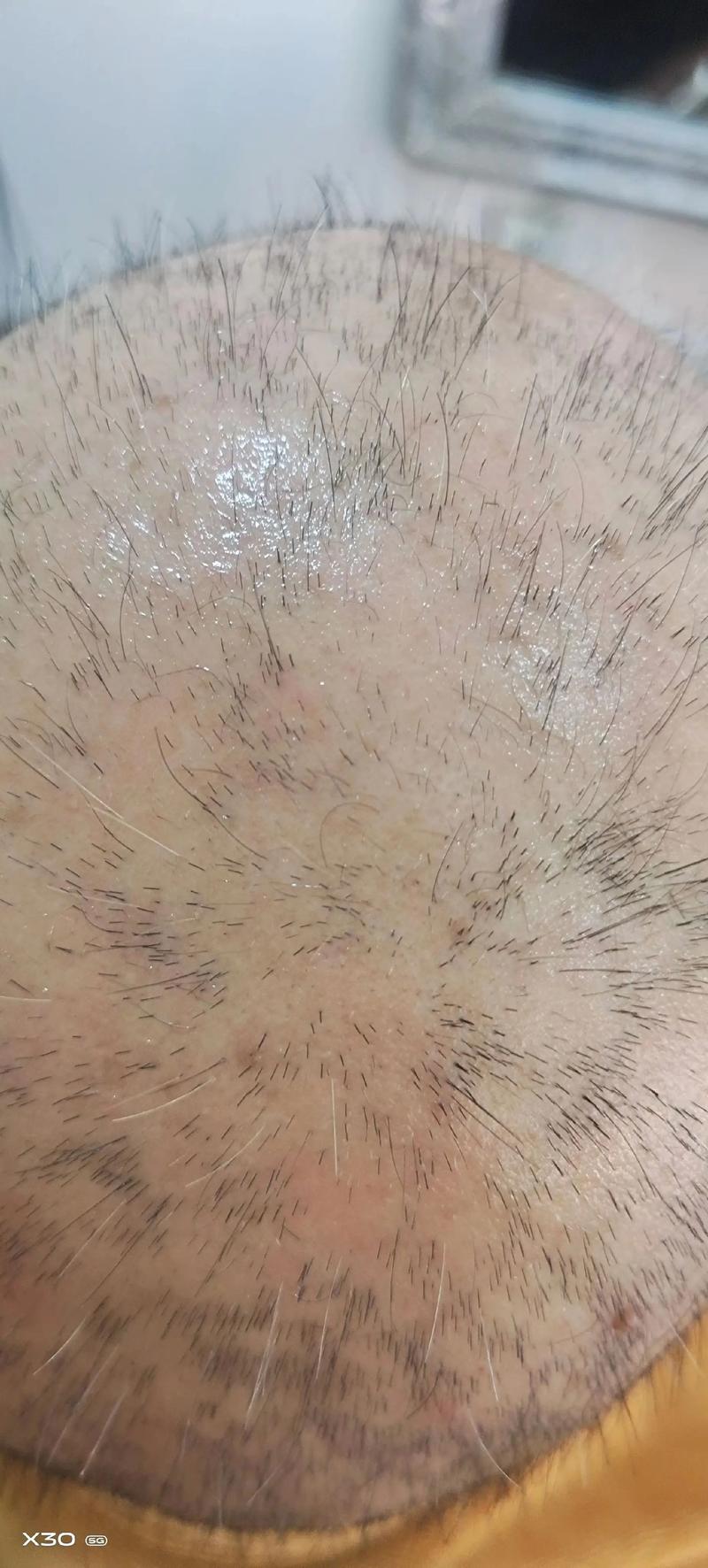 斑秃天天扎头发会不会越来越秃_扎发过紧伤头皮，易脱发，注意防护！