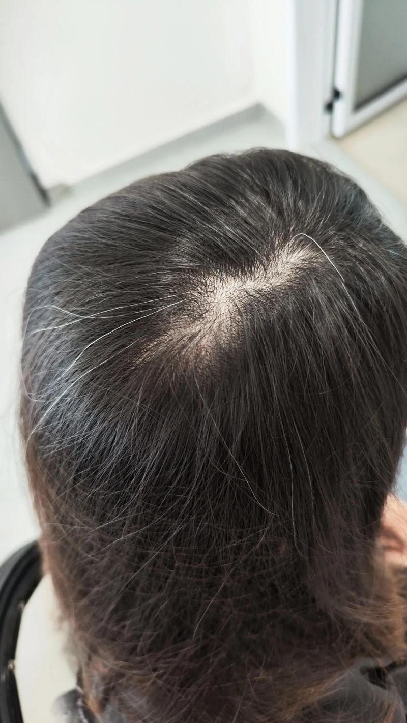 突然有一根白头发正常吗_偶尔白发不用慌,遗传熬夜都有关,密集需看医生 突然有一根白头发正常吗_偶尔白发不用慌,遗传熬夜都有关,密集需看医生