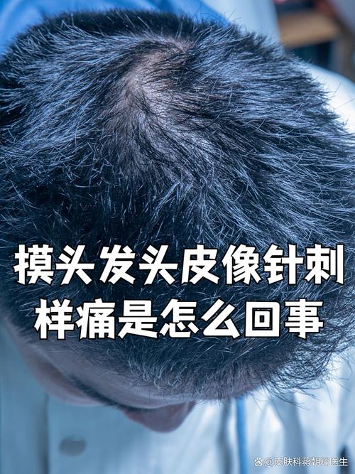 摸到头发头皮疼怎么回事_头皮神经痛怎么办?试试这些缓解妙招! 摸到头发头皮疼怎么回事_头皮神经痛怎么办?试试这些缓解妙招!