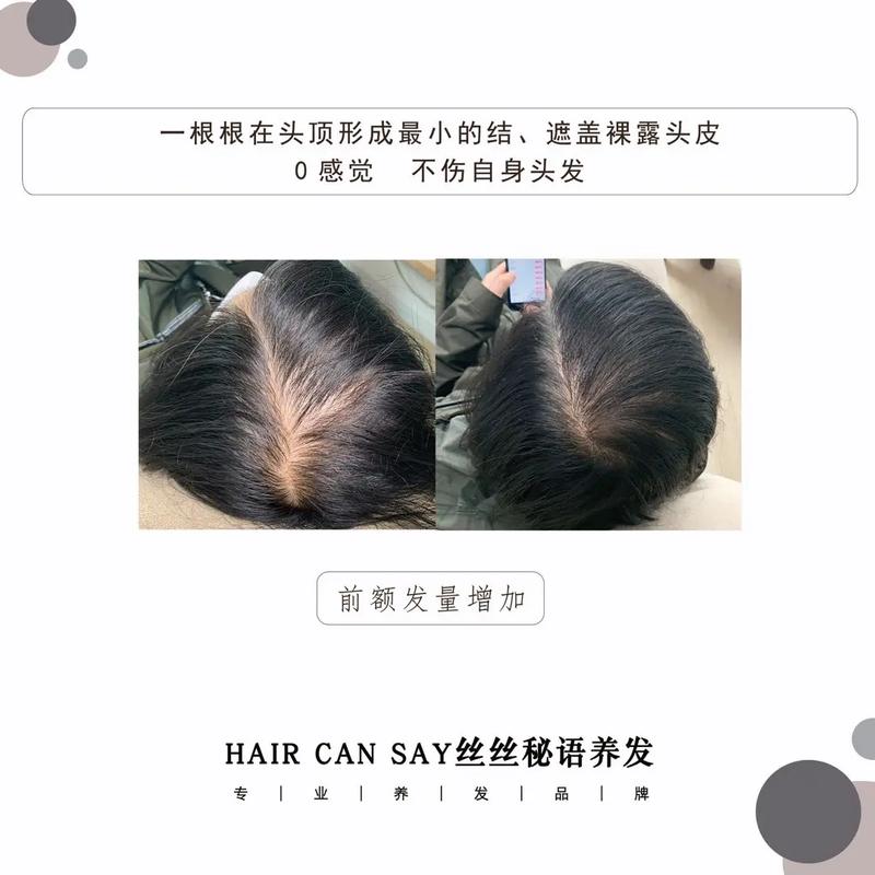 头中间头发稀少能恢复吗_头顶稀少能恢复吗?看原因! 头中间头发稀少能恢复吗_头顶稀少能恢复吗?看原因!