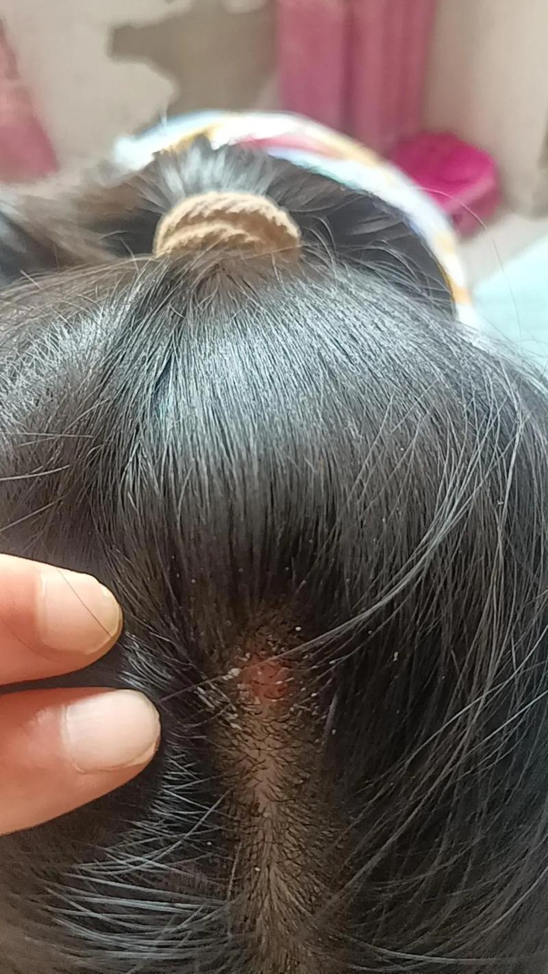 用力扯头发掉了还会长吗_毛囊断了还会长,营养作息很重要 用力扯头发掉了还会长吗_毛囊断了还会长,营养作息很重要