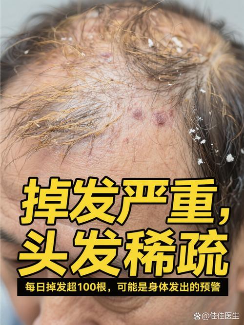 打黄体酮会掉头发吗_黄体酮或致脱发？因人而异需注意