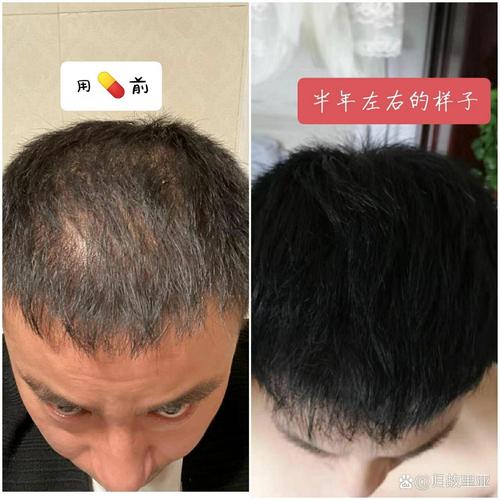 用米诺熬夜还能长头发吗_熬夜脱发米诺地尔管用吗？试试这方法！