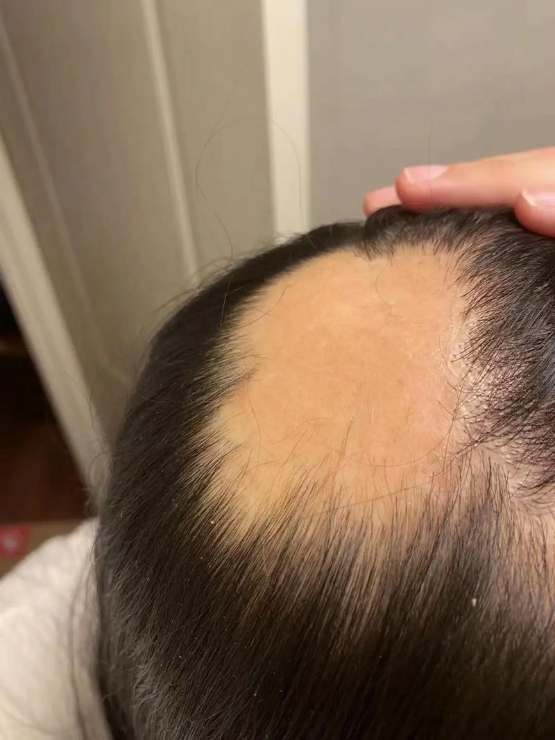 已经秃了的地方还会长头发吗_毛囊活着就能长头发？脱发原因很重要！