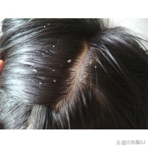 太久不洗头发头皮发黄_头皮发黄？快查查这原因！
