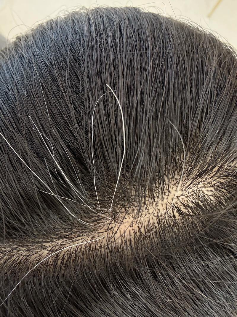 把白头发拔了会有什么后果_别拔白发!伤毛囊还可能更糟 把白头发拔了会有什么后果_别拔白发!伤毛囊还可能更糟