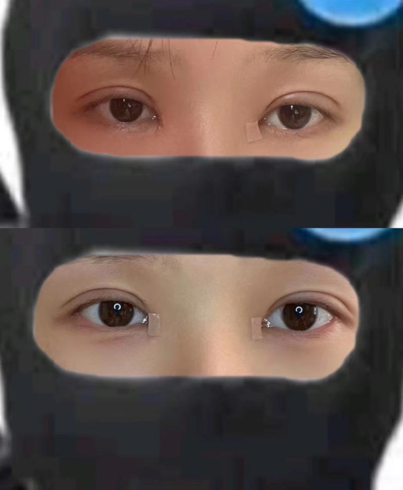 切完双眼皮多久能化妆_双眼皮恢复期化妆禁忌与注意事项 切完双眼皮多久能化妆_双眼皮恢复期化妆禁忌与注意事项