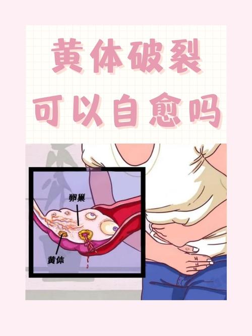 胆黄体破裂是什么情况_胆黄体破裂别混淆，腹痛及时就医是关键！