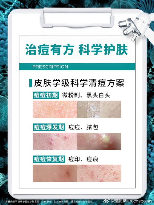 清完痘痘多久可以化妆_挤完痘痘要等一个月才能化妆，别急着上妆！