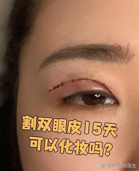 割双眼皮什么时候能化妆_全切拆线14天，埋线5-7天可化妆