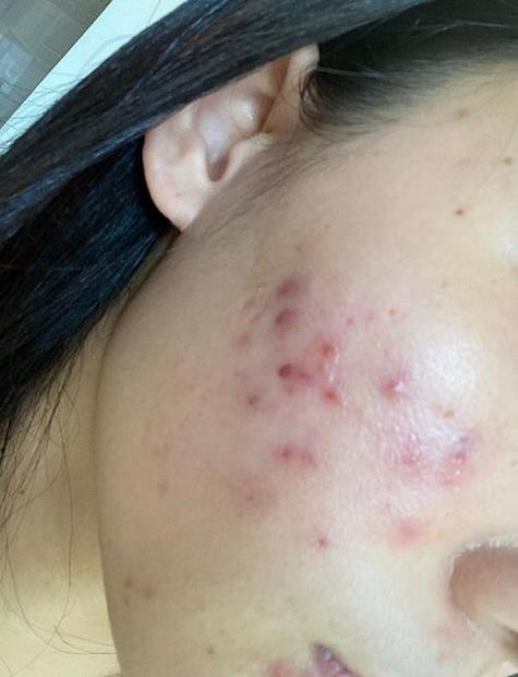 破口痘痘愈合时能化妆吗_痘痘未愈莫化妆，防晒饮食助愈合