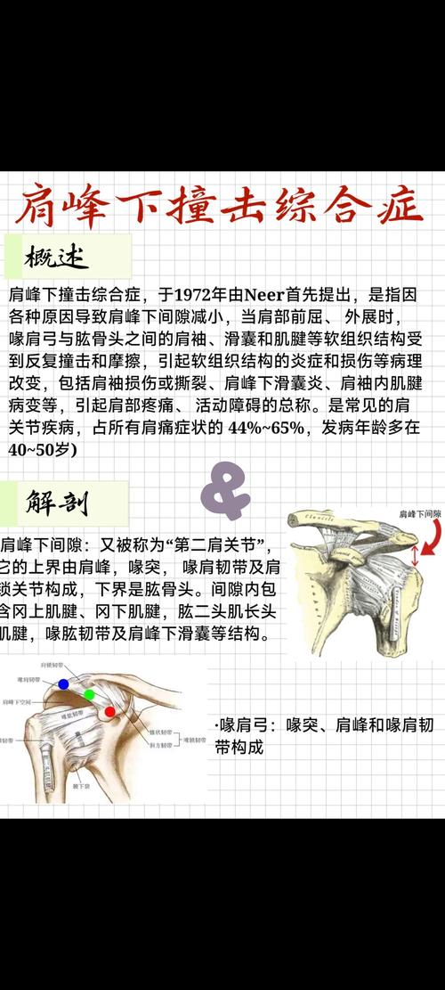 肩峰撞击还能健身吗_肩峰撞击别怕，温和运动来缓解