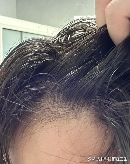 跑完800头发会油吗_运动后头发油腻?这样洗护更清爽! 跑完800头发会油吗_运动后头发油腻?这样洗护更清爽!