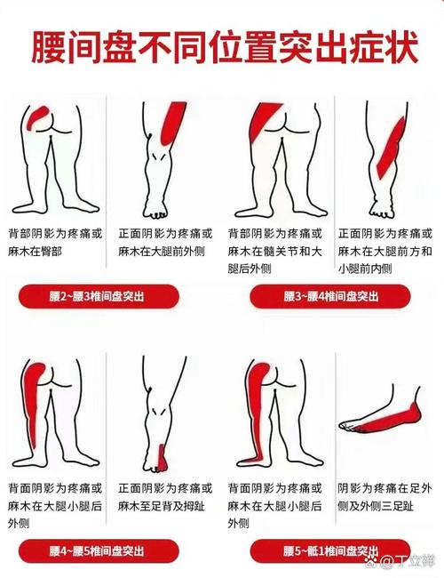 腿弯疼痛部位对照表_肌筋膜炎坐骨神经痛等
