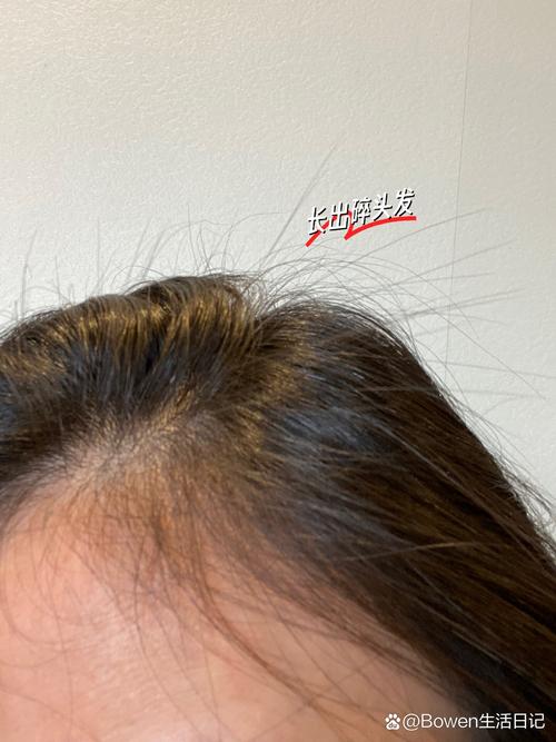 不长头发用姜涂抹_生姜涂抹头皮助生发，效果因人而异