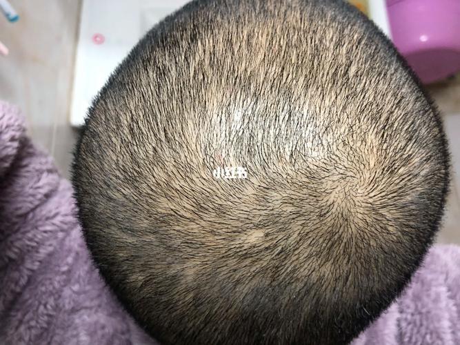 毛囊坏死了还能长出新头发吗_真假之分与修复保养