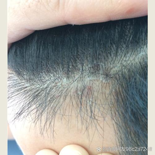 用二硫化硒后头发狂掉_洗头掉发多？用对洗剂护头皮！