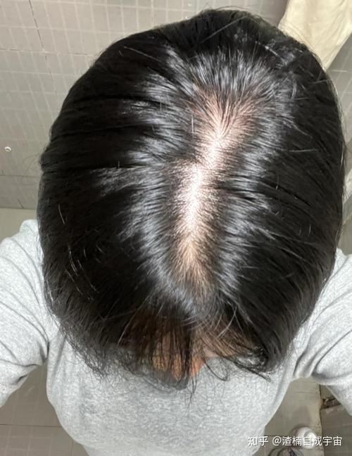 薅头发掉了十几根正常吗_洗头掉发多？查查原因，调整就好！